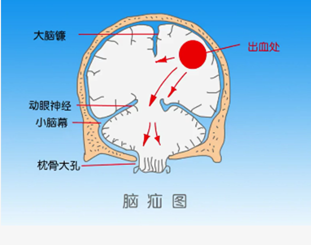 脑疝图片及图解图片