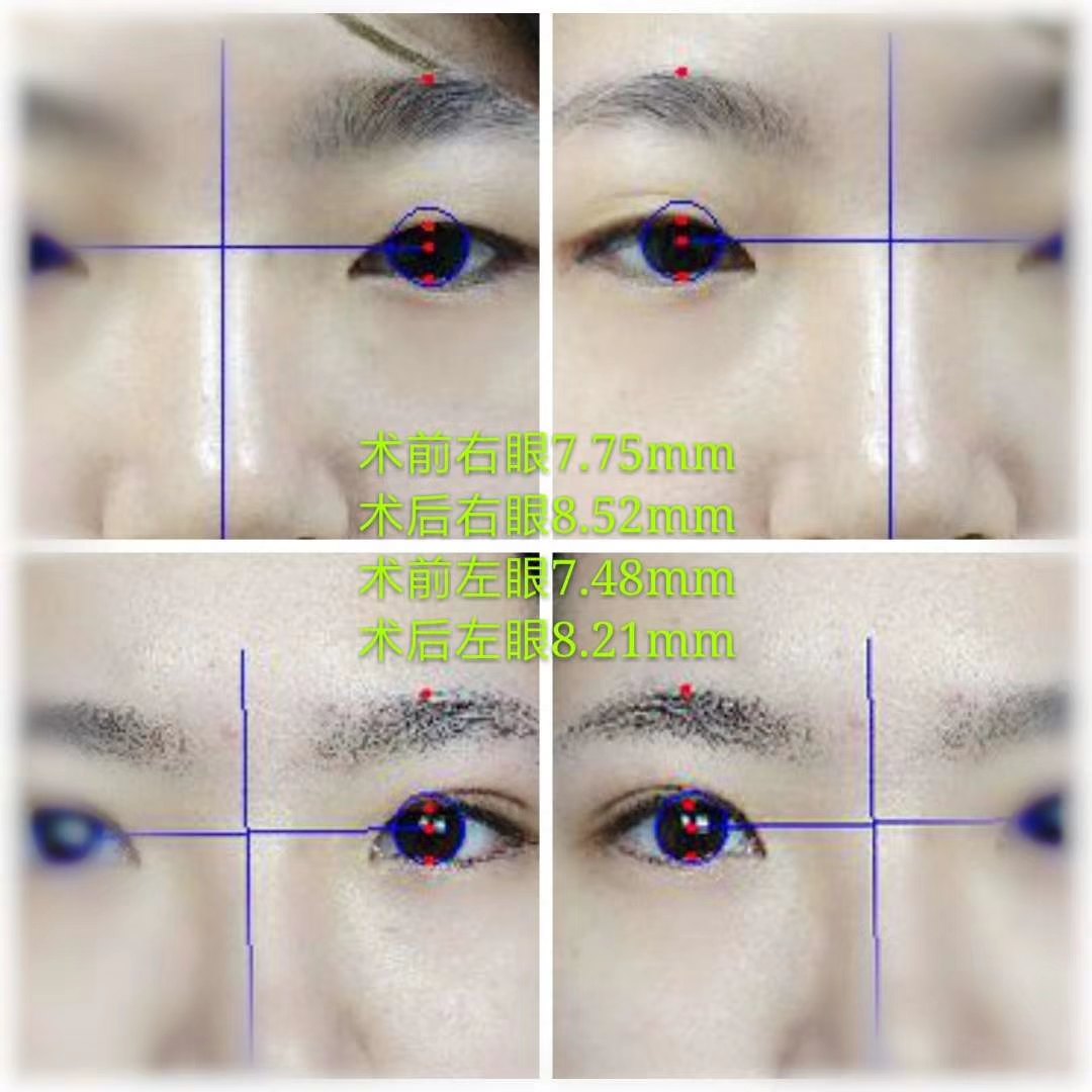 20 小美女,术前眼皮松弛,略臃肿,眼球暴露率偏低,显得无神;双眼皮 上