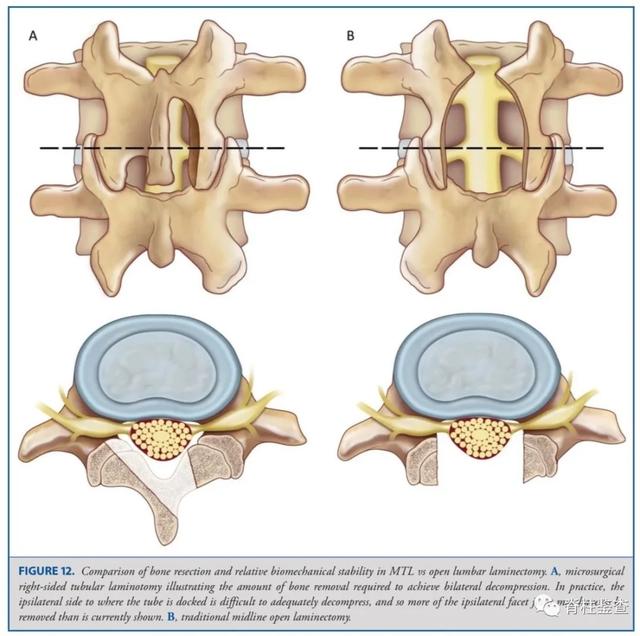腰椎微创病例汇报(从显微通道减压→mis