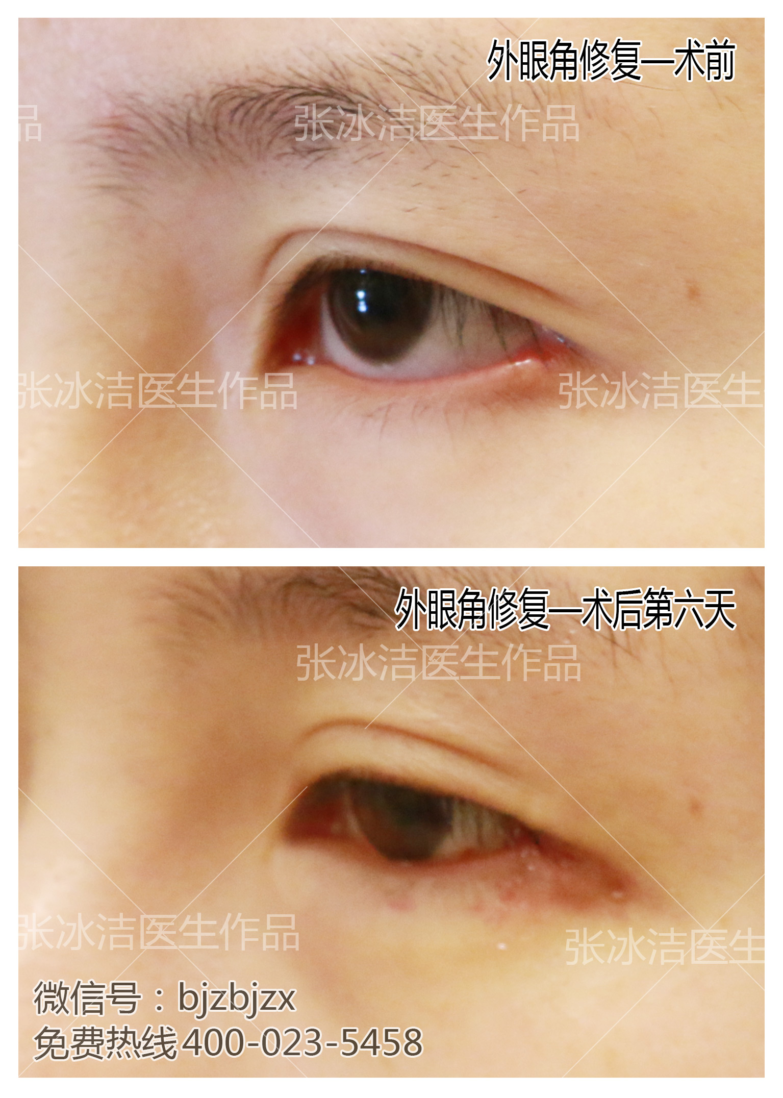 外眼角开大修复之后下睑外翻如何修复?