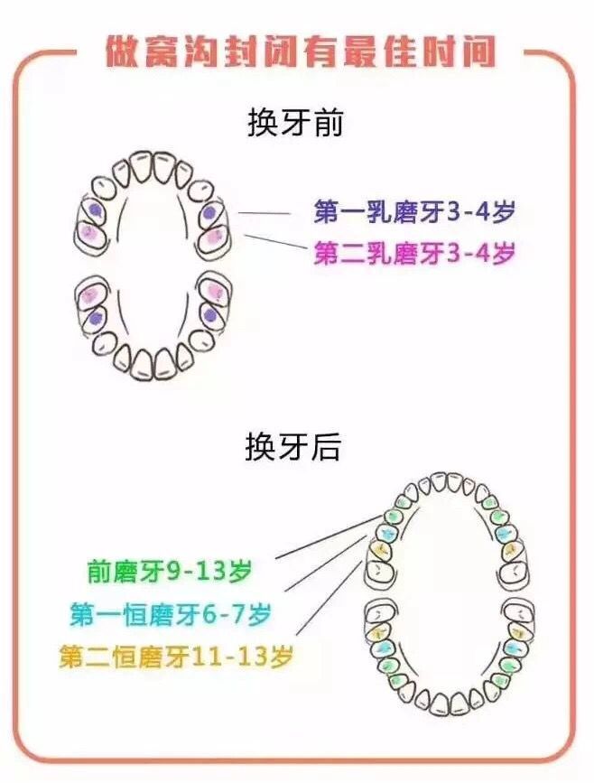 第二顆恆牙長出,這時候媽媽們千萬別忘記給它也做窩溝封閉哦!