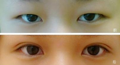 眼综合整形术小眼睛的终极选择
