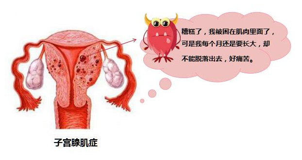 腺肌症治療,把子宮內膜切了就能好嗎?