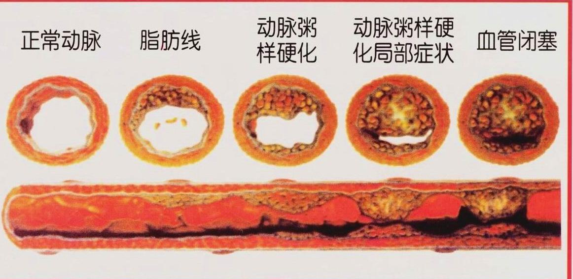 保健品抗血栓不靠谱小心被忽悠