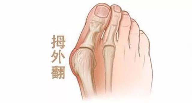 1,选择宽松甚至露趾的鞋子;穿戴拇外翻护垫,分趾垫及夜间使用外展支具