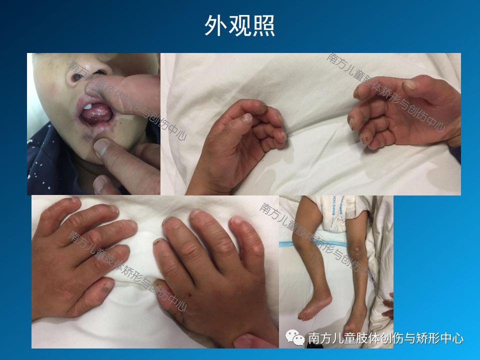 无法感知疼痛不会流汗的世界无痛无汗症