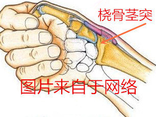 手指腱鞘炎的发病原因及治疗方法