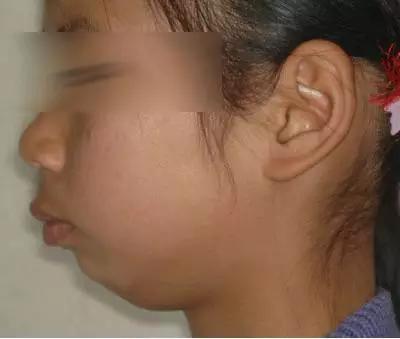家长必看:孩子15岁前必须处理的11种畸形牙齿