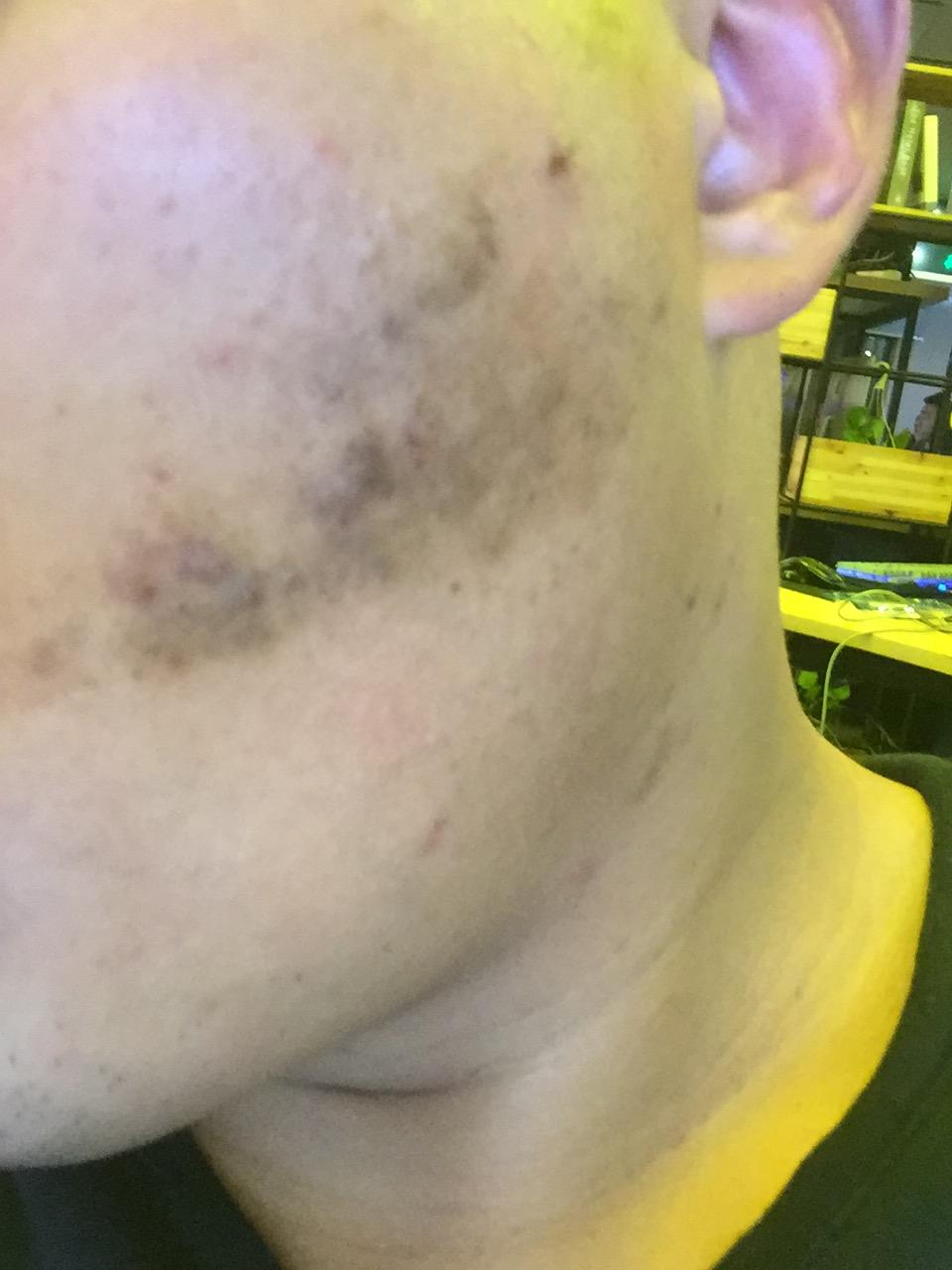 依然存在的毛细血管扩张而产生的红色痘印,褐色痘印都有非常好的疗效