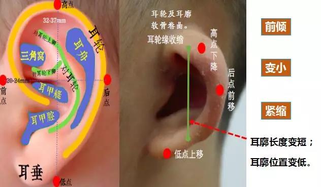 耳轮缘紧缩:耳轮及耳廓软骨卷曲和粘连,耳轮脚位置向前,下移位.