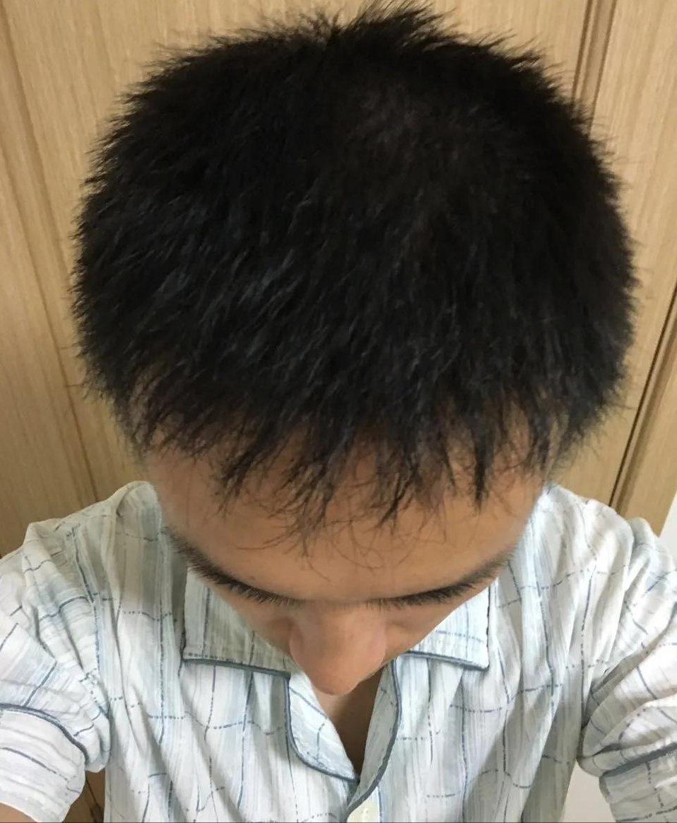 脱发10年严重稀疏光裸,仅一年时间已救回大半!