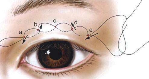 埋线双眼皮到底能坚持多长时间?几年or终身?取决于它