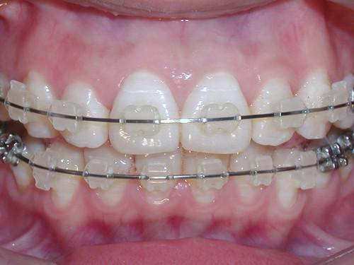 儿童牙齿矫正的方法有哪些