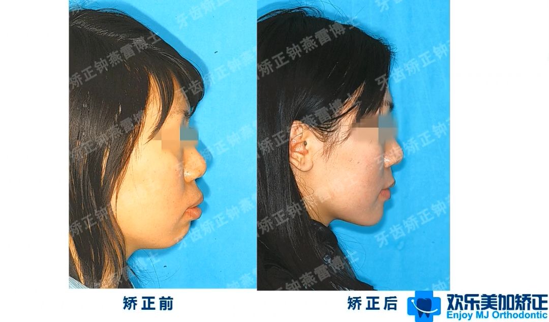 牙齿矫正真的可以改变面型吗 钟燕雷主治医师 爱问医生