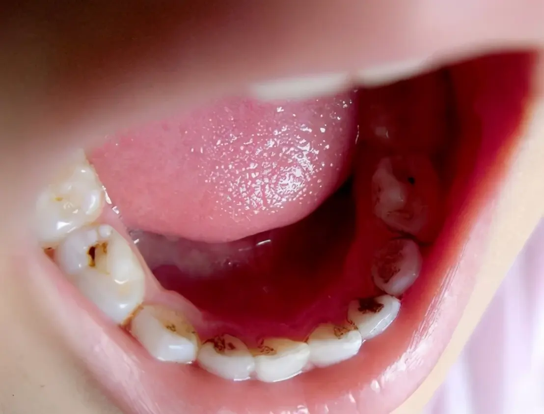 正畸失败 严重牙槽骨吸收 牙龈萎缩 牙齿松动三级 矿化牙隐裂我该怎么办?