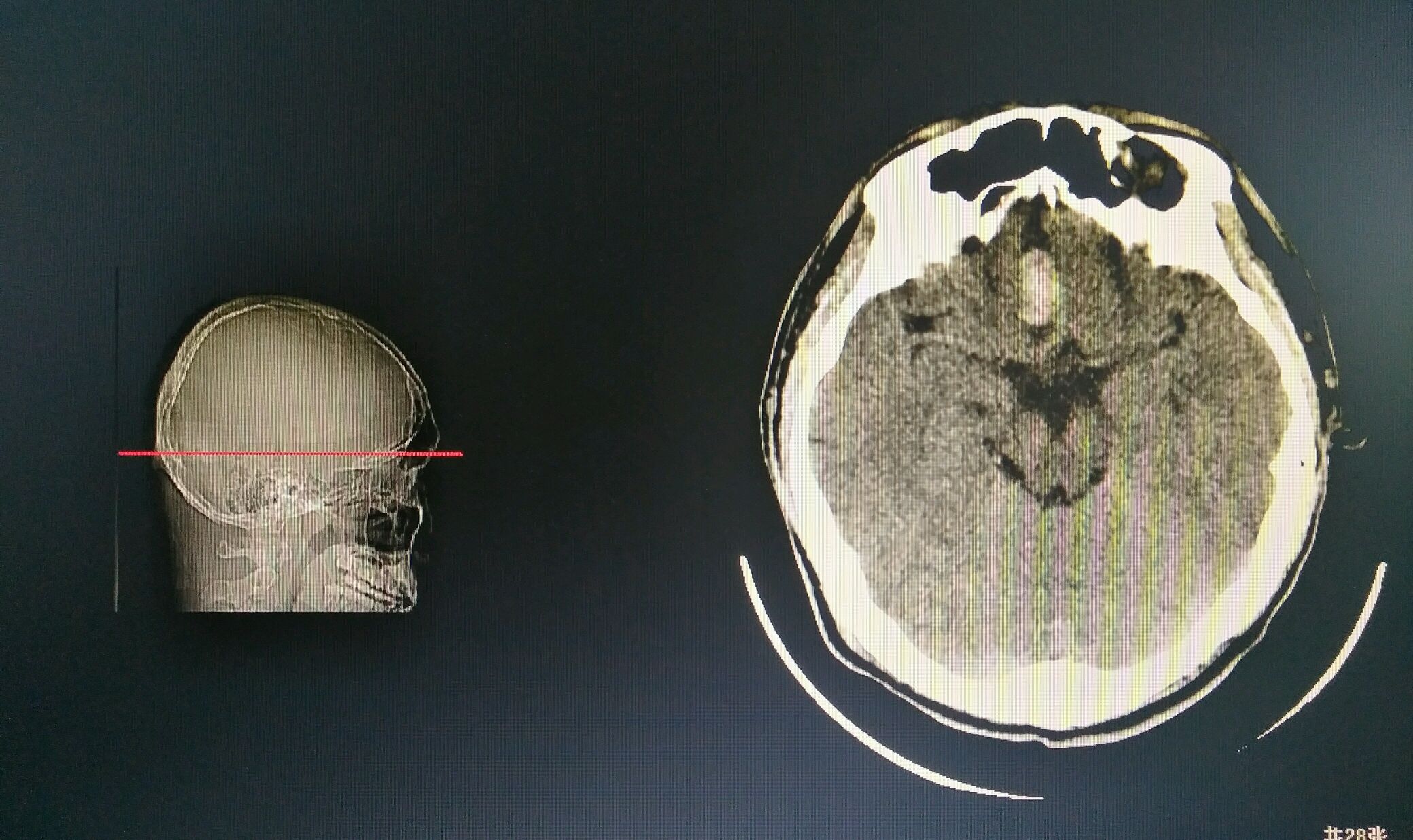 脑出血死亡的重要原因