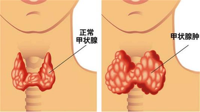 为什么女人更容易得甲状腺疾病?