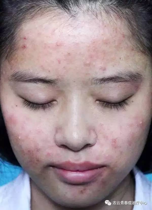 面部过敏和面部痤疮有什么不同?