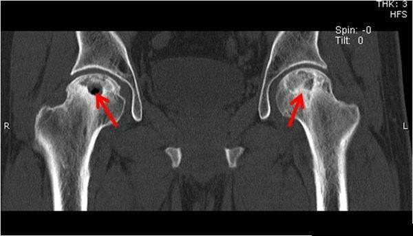 关节面塌陷变扁,关节间隙狭窄,髋臼出现坏死变化,囊性变,囊肿和骨刺Ⅳ