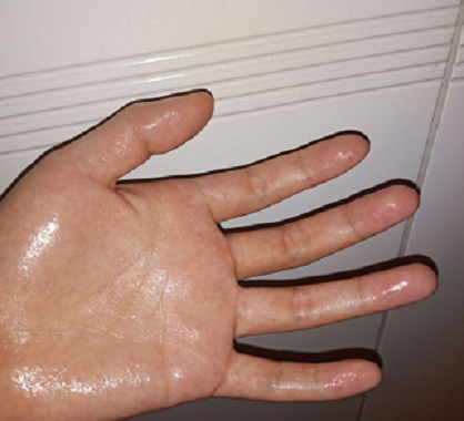 造成手汗症的原因有哪些呢