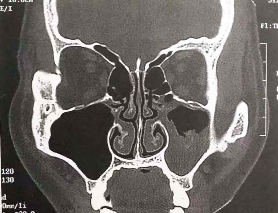 圖文解說:鼻竇真菌感染的ct診斷