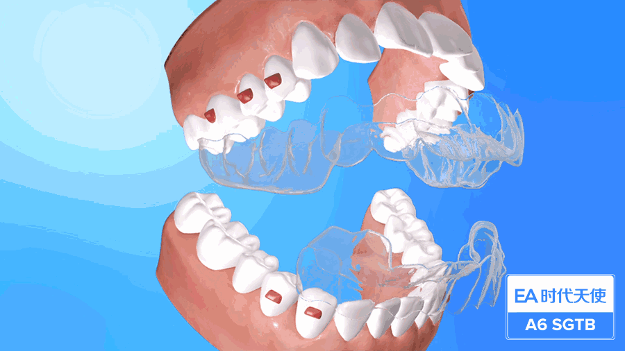 如果你本身属于"低角"面型,也就是我们说的国字脸,就特别适合磨牙远移