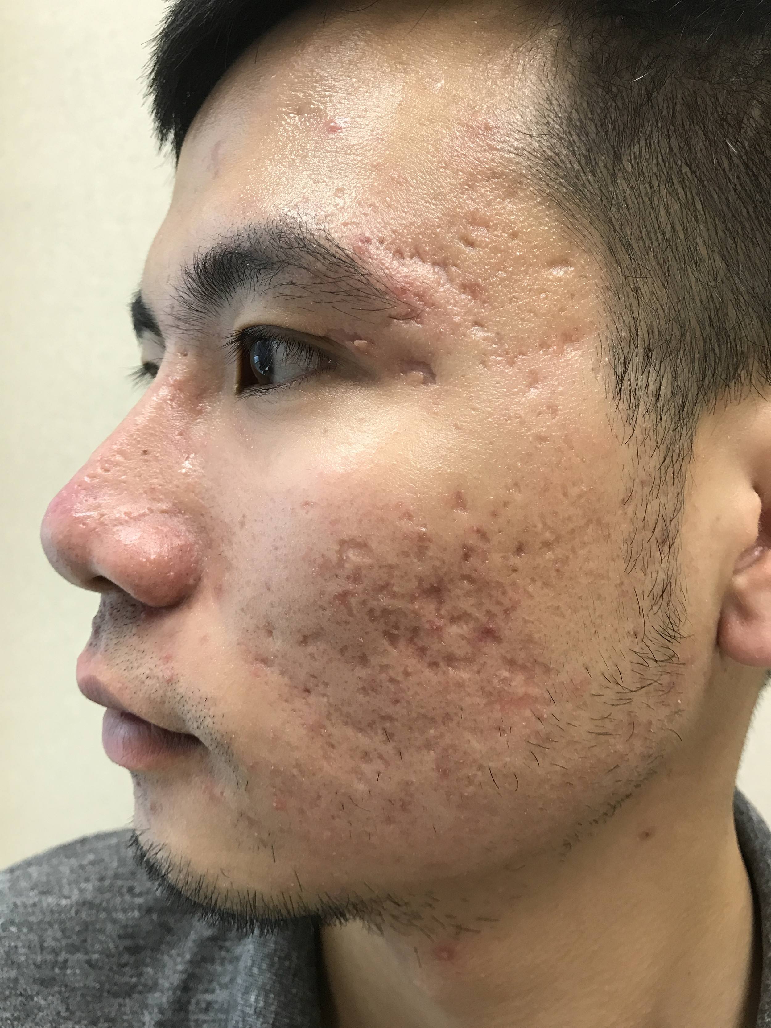 纤维加热至55℃-65℃,破坏皮脂腺以及痤疮,有效刺激组织再生,填平痘坑