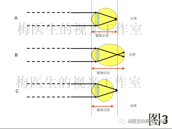 a 正視眼看遠時,焦點正好在視網膜上成像