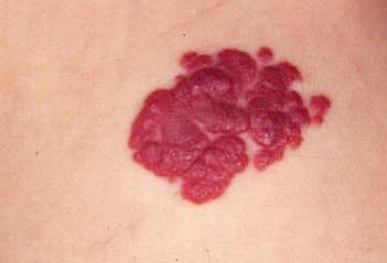 (2)新生儿斑痣区分方法:病患区皮肤呈淡红色或浅蓝色,常位于头顶中线