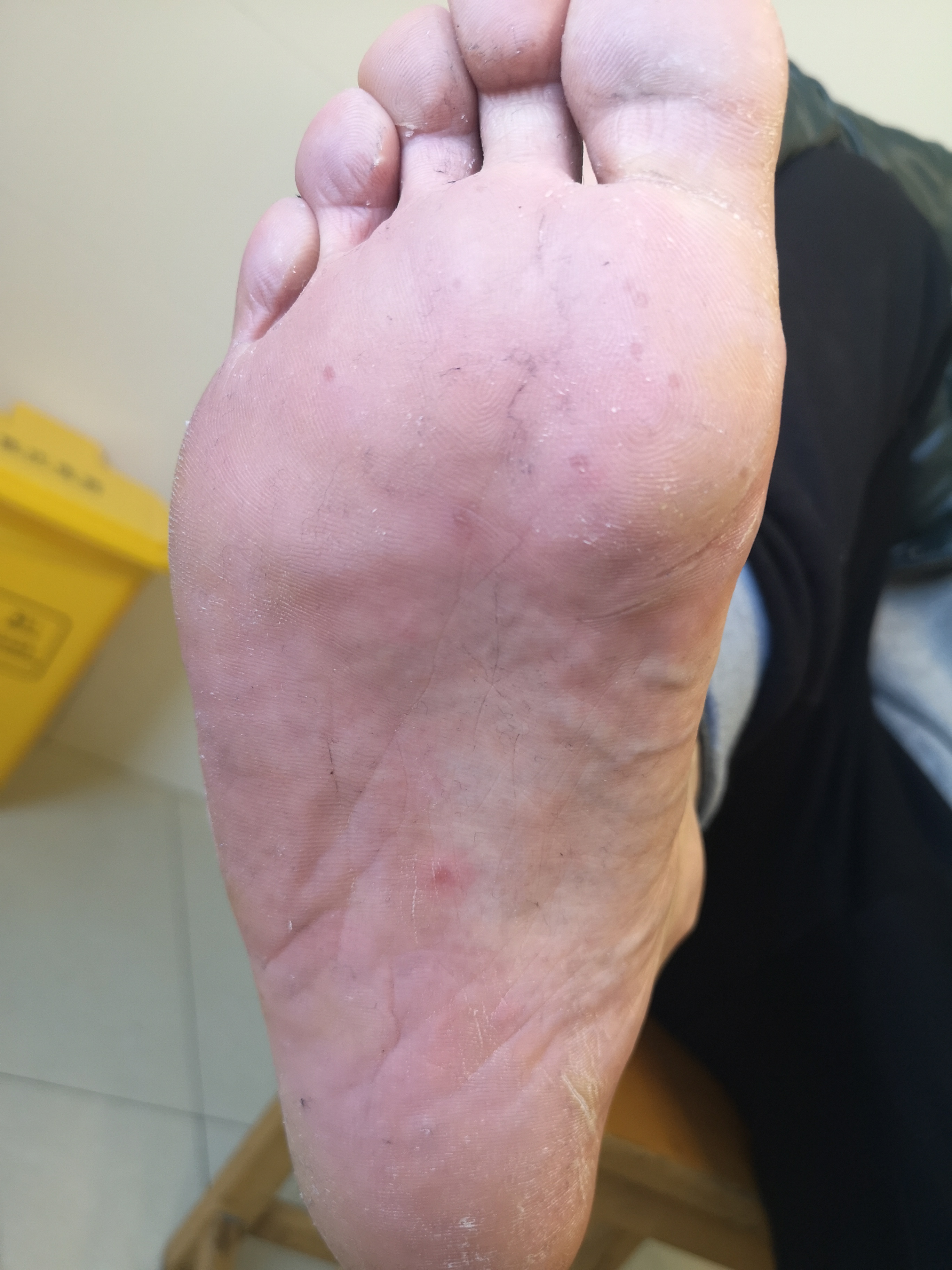 手足口病or多形红斑