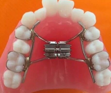 因磨牙前移导致的牙弓长度缩短,牙弓狭窄是口腔正畸临床常见的问题,由