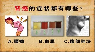 血尿会是肾癌吗?肾癌有什么症状?