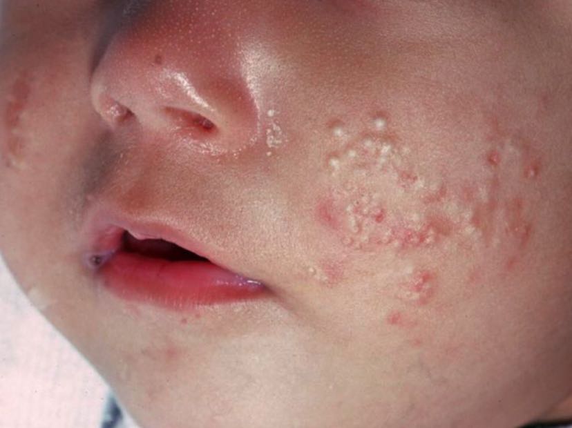 新生儿痤疮和湿疹图片图片
