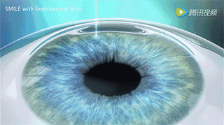 想做近视手术你该知道的飞秒全飞秒icl人工晶体植入术