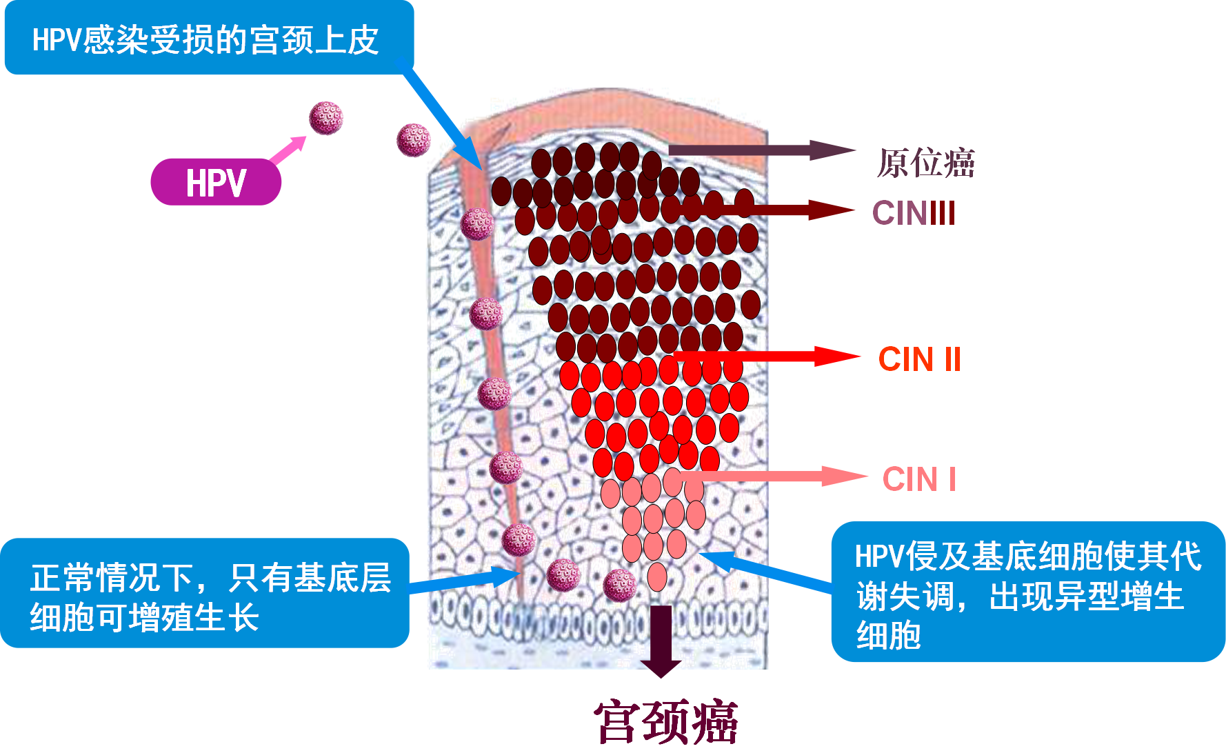 预防宫颈癌,hpv疫苗打还是不打?