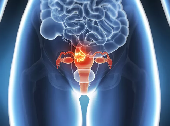 揭秘多囊卵巢综合征