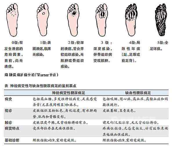 骨關節破壞或假關節形成,部分肢端可出現溼性或乾性壞疽;3級:肌腱韌帶