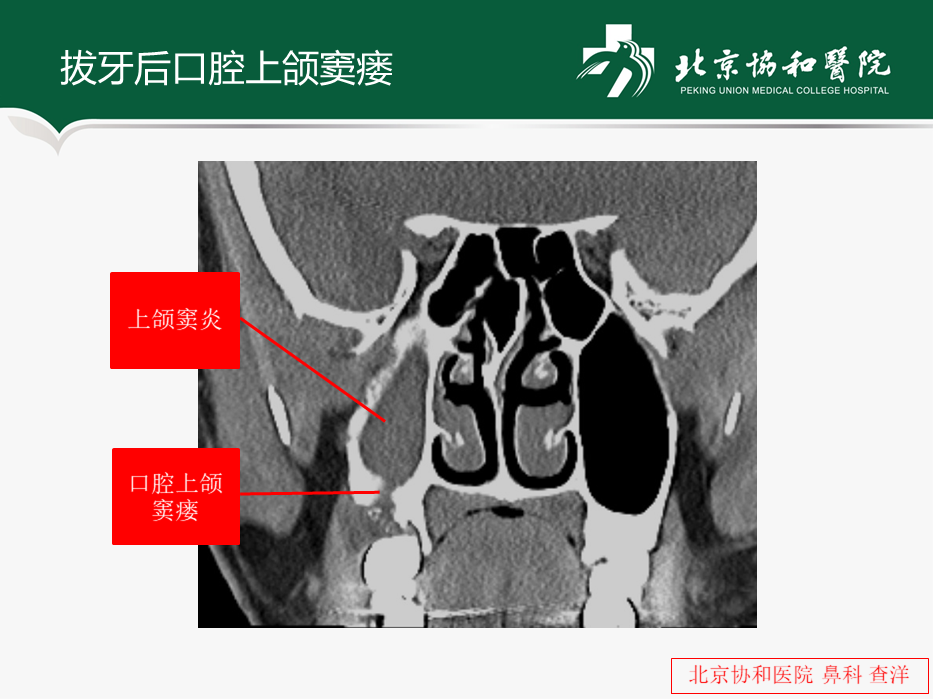 引起牙源性鼻竇炎的常見的牙科疾病包括根尖炎,根尖周圍炎,根尖囊腫