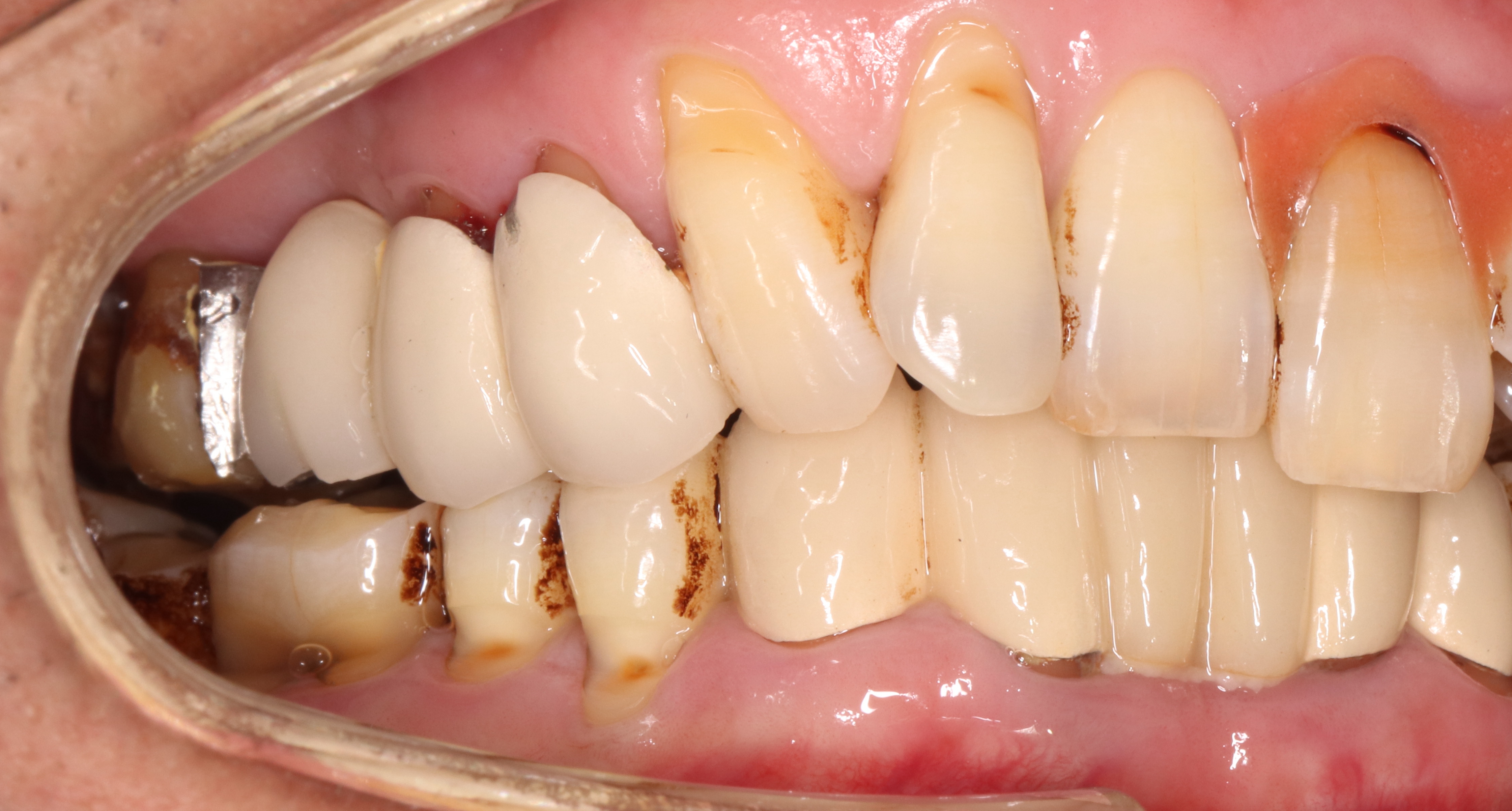 这个假牙用了两年 边缘不密合 结果患者感觉到牙疼拆除牙冠