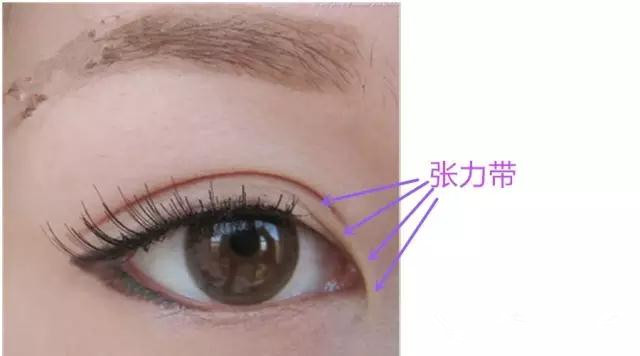 内眦赘皮对重睑线的选择是有影响的