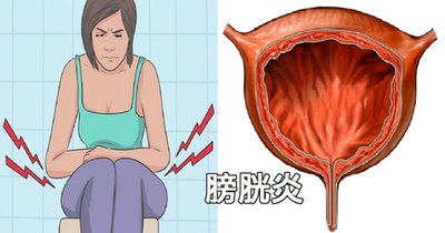 女性腺性膀胱炎图片图片