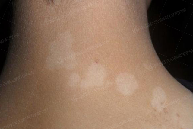 早期白斑脱色程度轻.