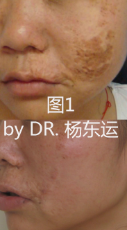 扩张器手术的常见并发症