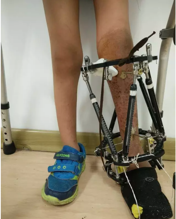 肢体延长矫形案例