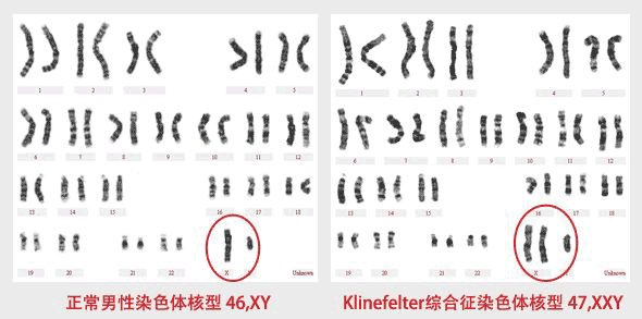 klinefelter综合征(无精子)就医指南