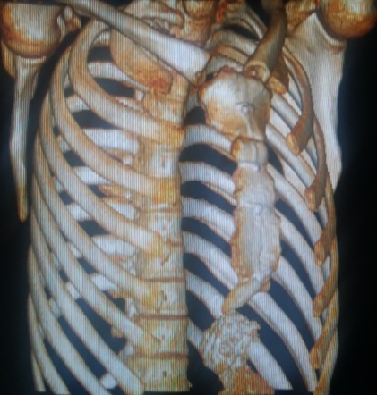 心脏手术后胸骨突出图图片