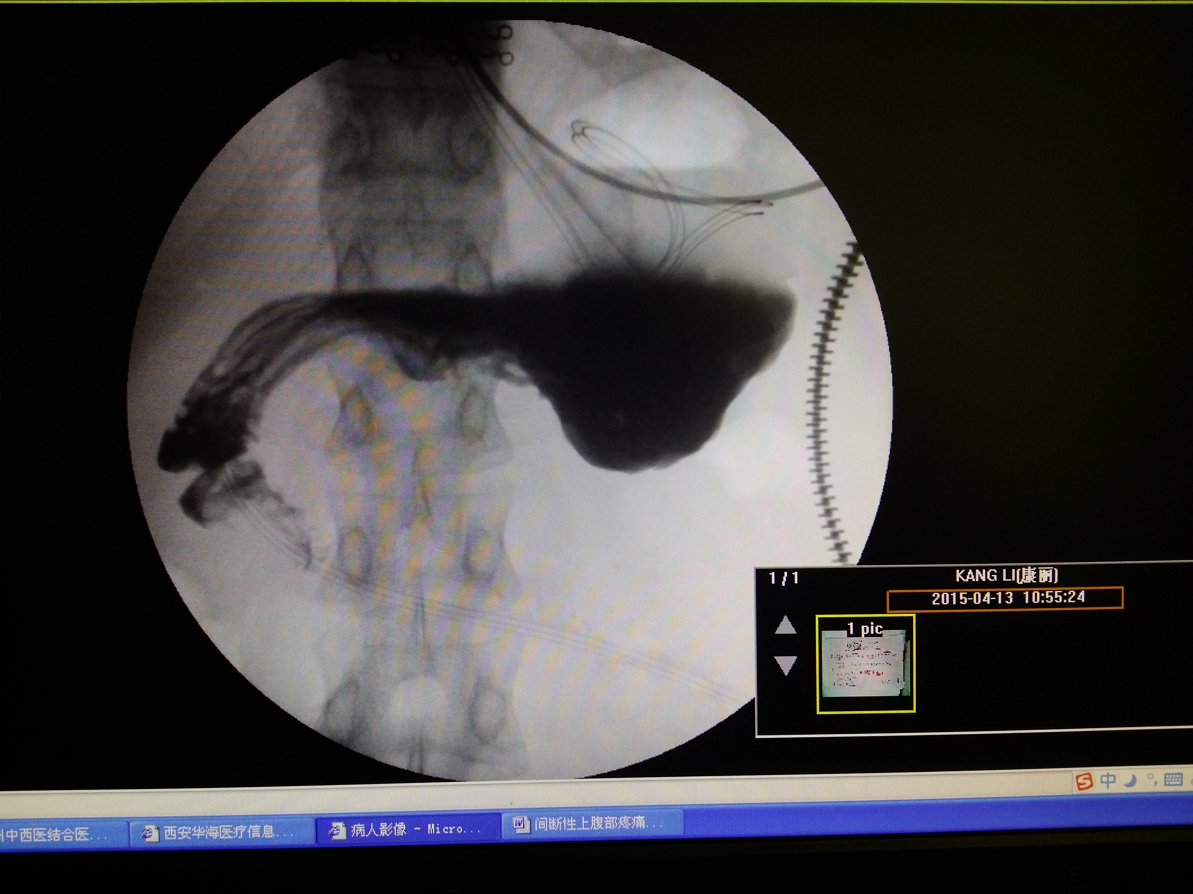 术后胃瘫医案附患者治疗前后消化道造影对照