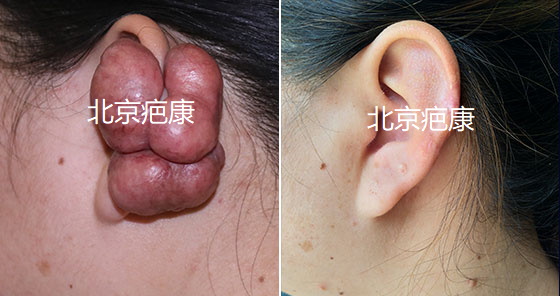 瘢痕疙瘩为什么很多大医院都治不好?-田利钊主治医师-爱问医生