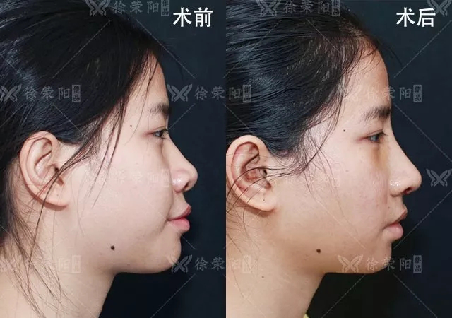 朝天鼻要怎么矫正?