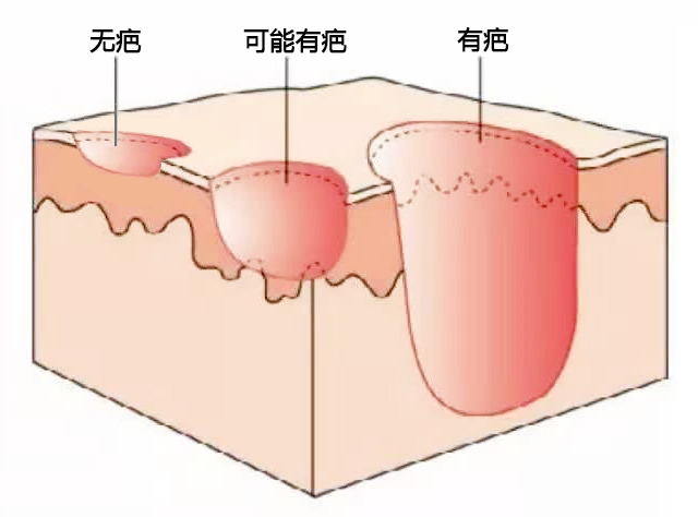 真皮层又分为乳头层(较表浅)及网状层.